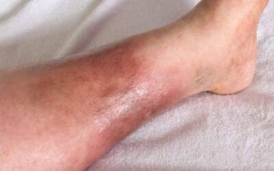 Common Risk Factors for Vein Disease