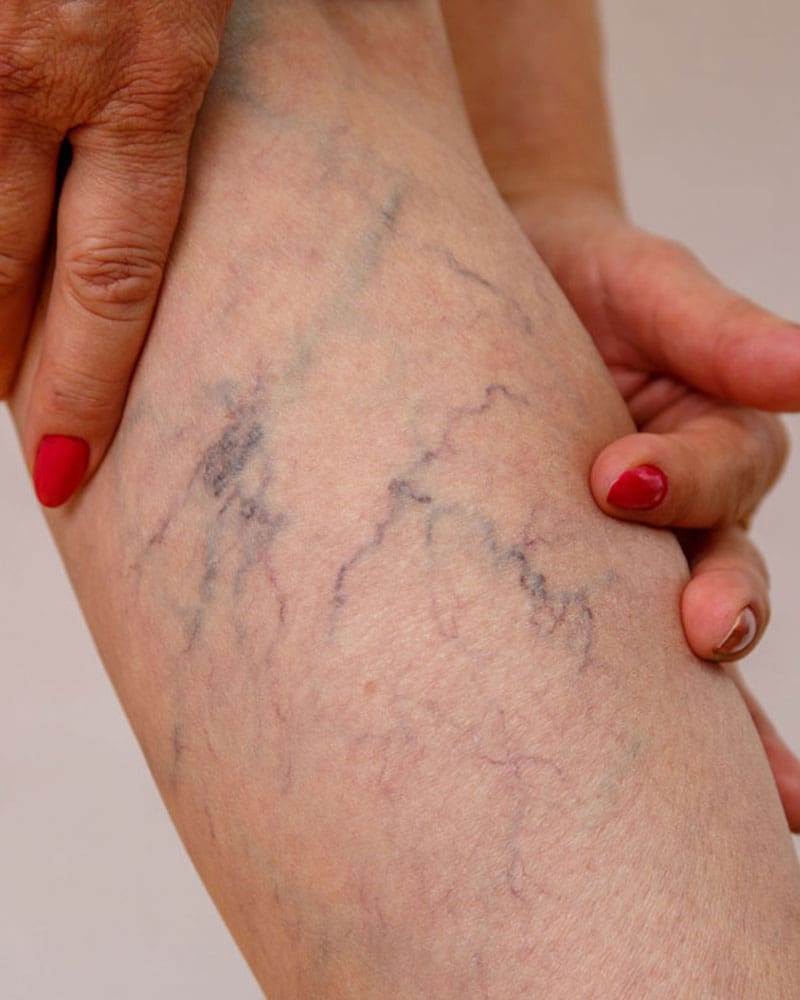 Causes Spider Veins Mod Image Causes Spider Veins Mod Image