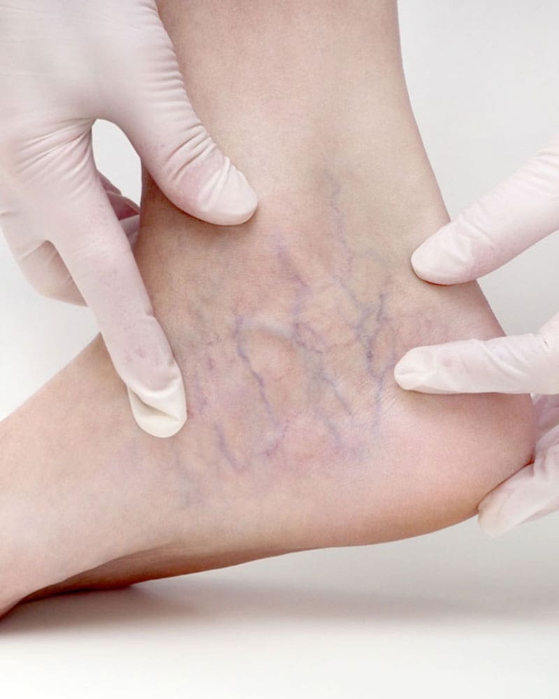 Get Rid Of Spider Veins Mod Image Get Rid Of Spider Veins Mod Image