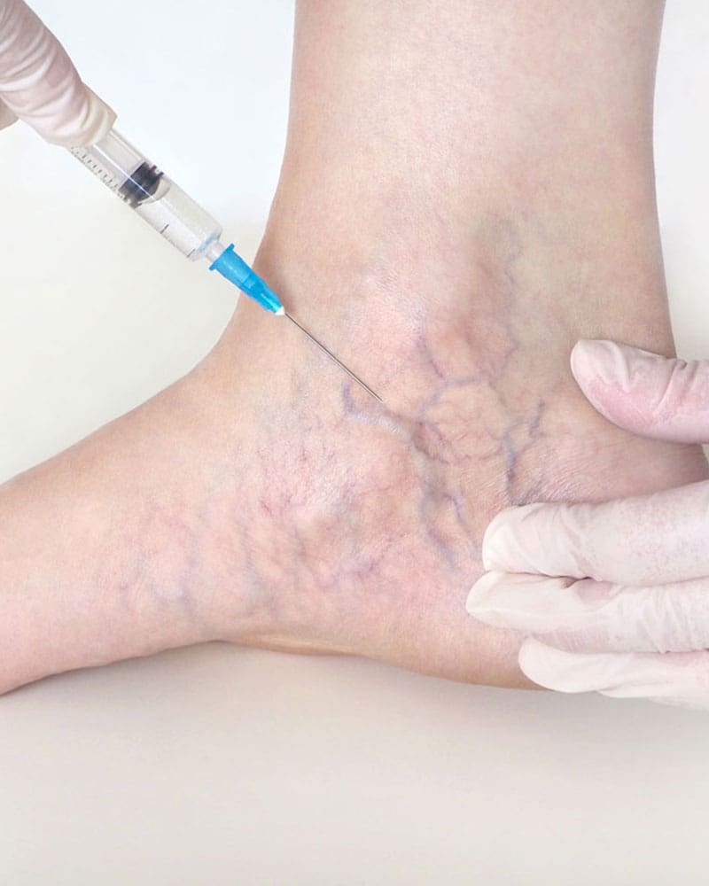 Sclerotherapy Treatment Mod Image Sclerotherapy Treatment Mod Image