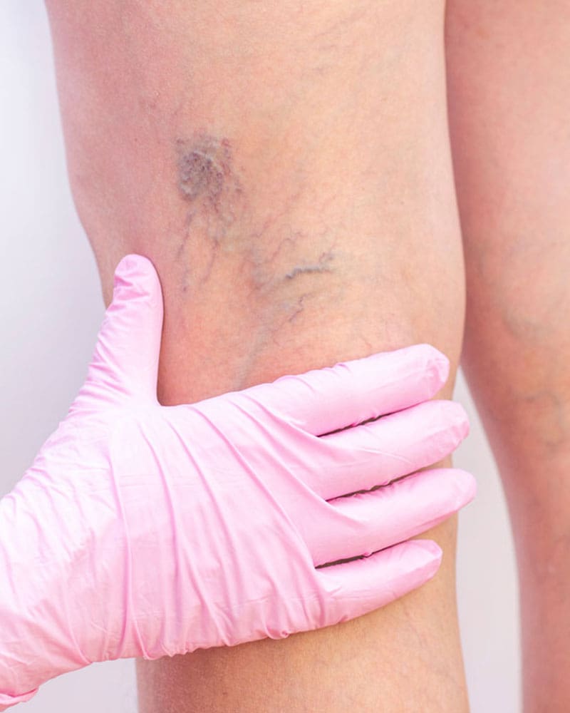 Spider Veins Hs Mod Image Spider Veins Hs Mod Image