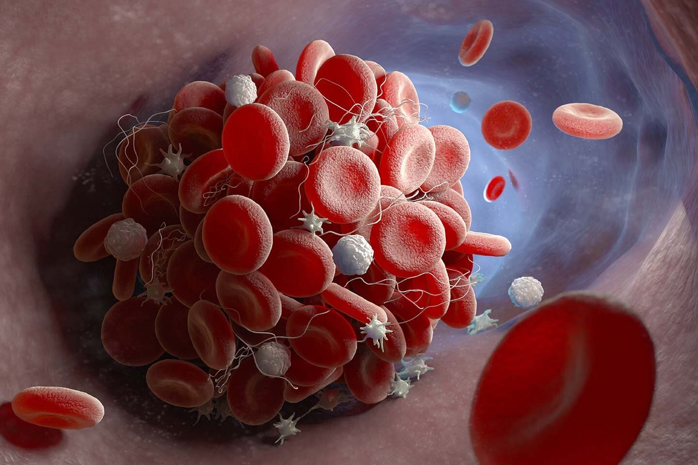 Covid 19 Vaccine and Varicose Veins | Blood Clots | Vein Institute