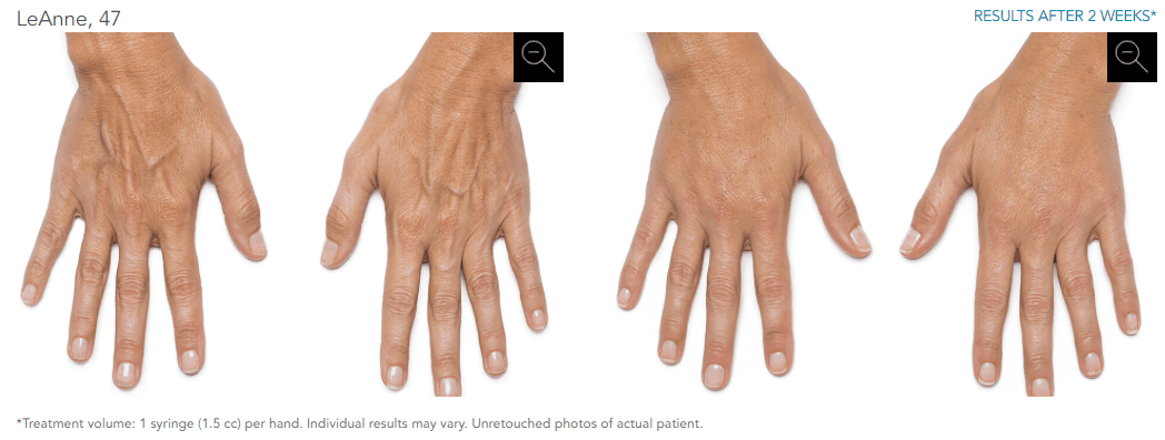 Vein Institute | Radiesse for Hand Veins