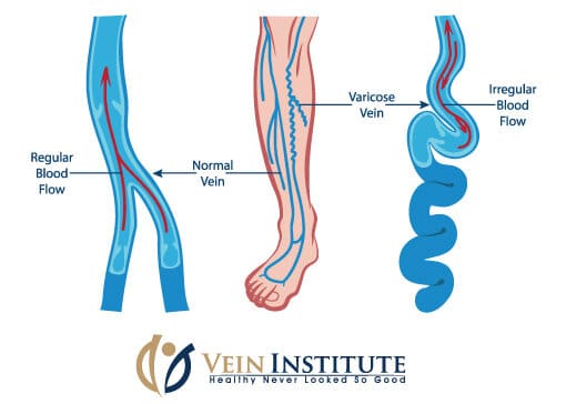 Vein Institute | Varicose Veins and The Risk of Blood Clots