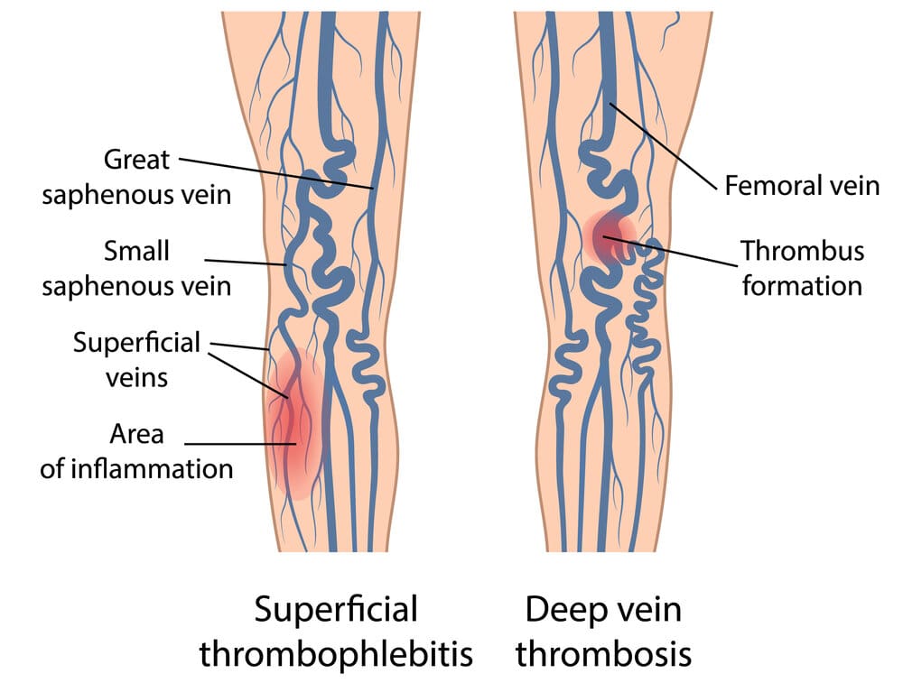 Vein Institute | Varicose Veins and the Risk for Blood Clots