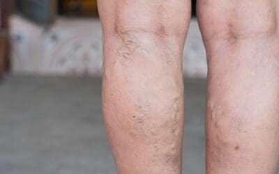 Spider Veins vs. Varicose Veins: How to Tell Them Apart, and What You Can Do