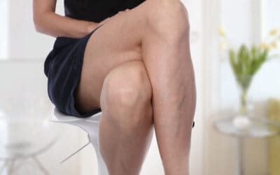 What are Varicose Veins?