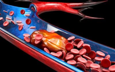 What is DVT?