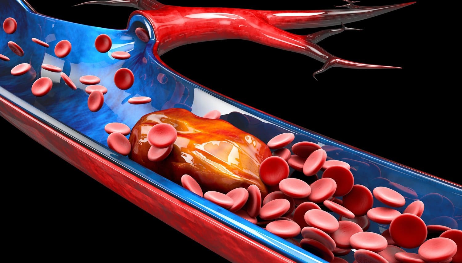 3d,Illustration,Of,Deep,Vein,Thrombosis,Or,Blood,Clots.,Embolism.
