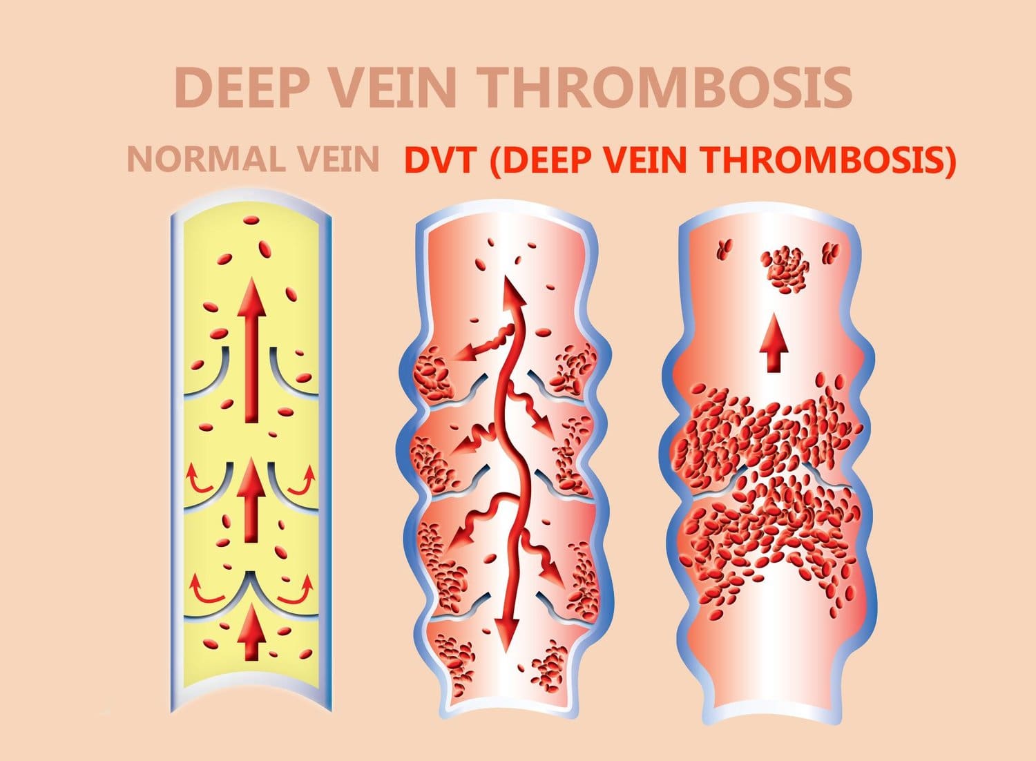 Deep Vein Thrombosis (DVT) | Vein Institute | Connecticut | Top Vein Doctor | Leg Pain