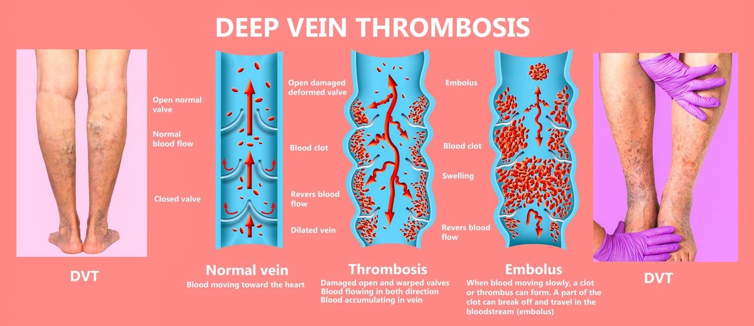 Deep Vein Thrombosis | Vein Institute | Vein Doctor Connecticut | DVT