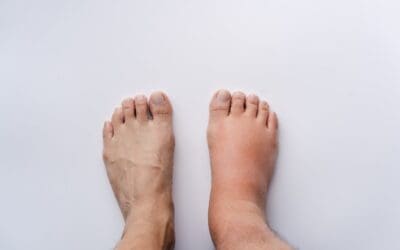 Swelling (Edema) Could Be a Sign of Vein Disease
