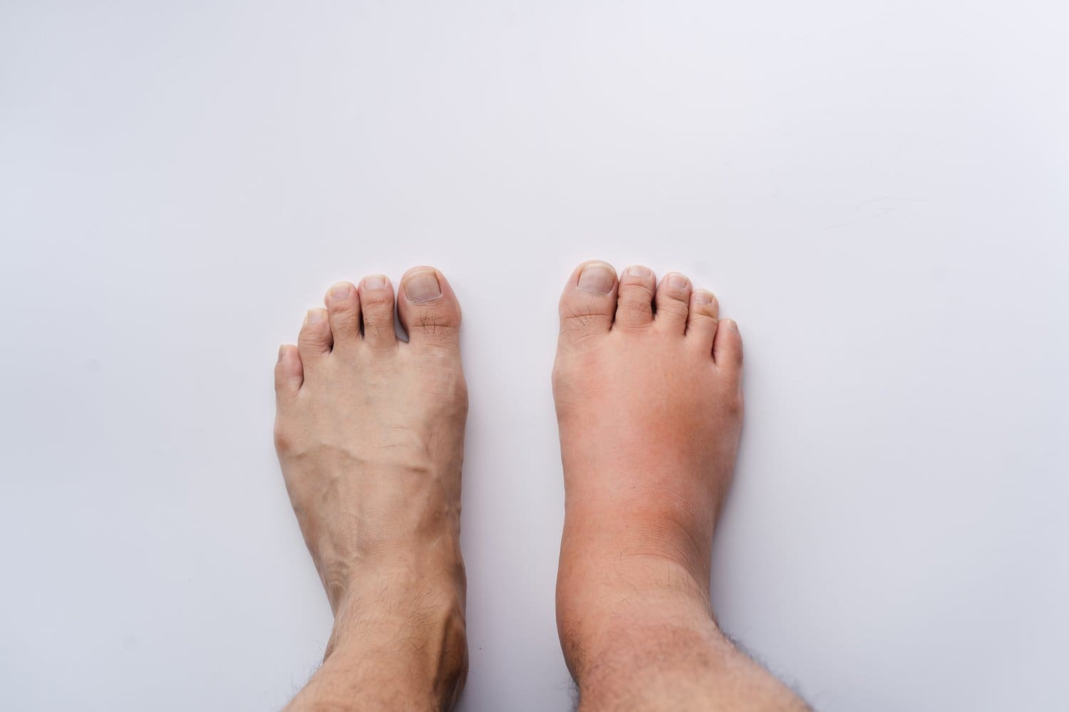 Right,Feet,Sprain,Swelling,From,Trauma,On,White,Background.