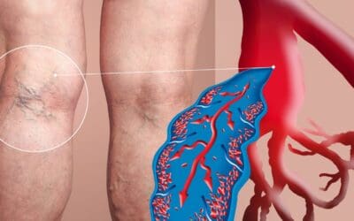 DVT Awareness Month