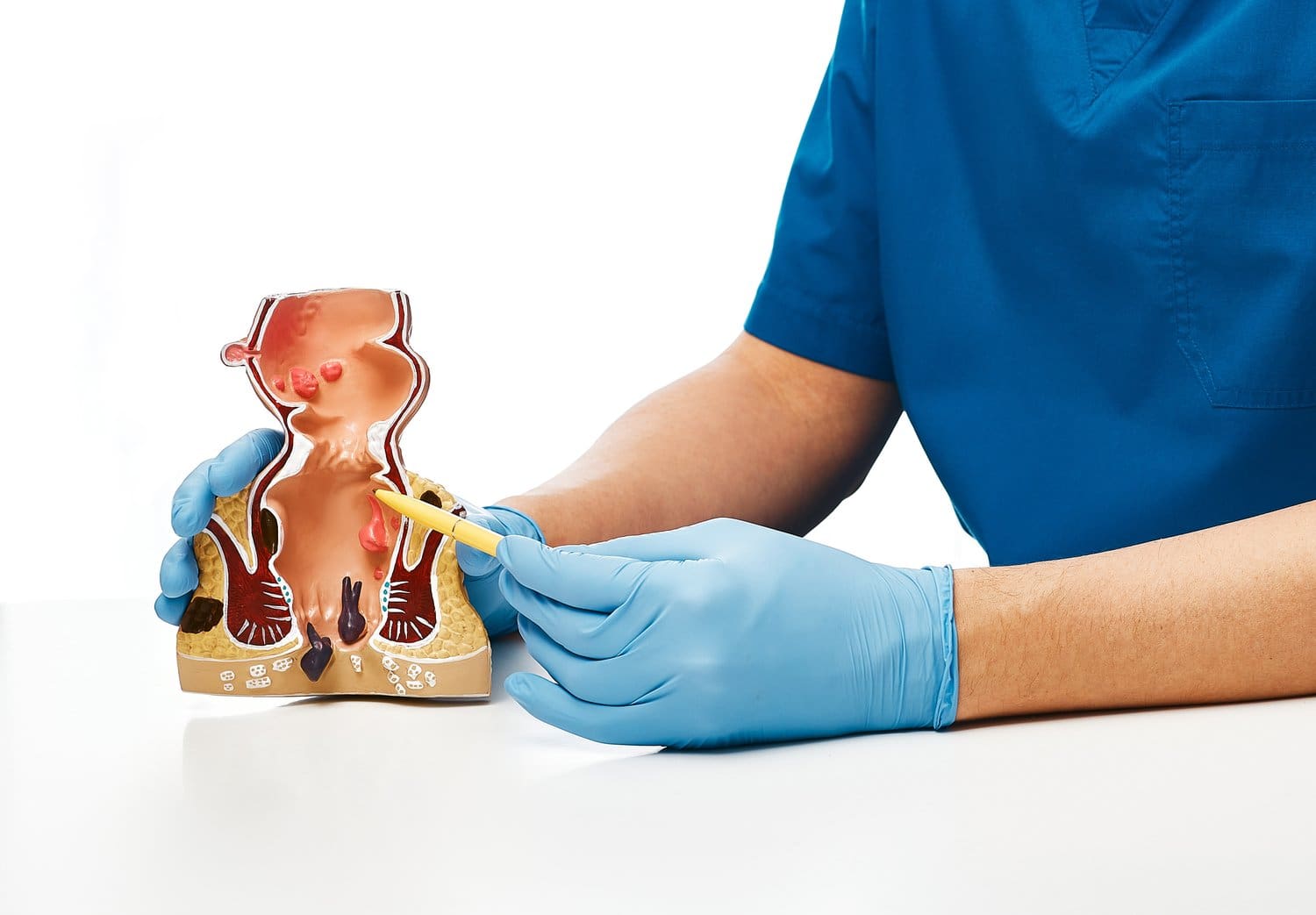 Proctologist,Pointing,Pen,Rectum,Pathologies,On,An,Anatomical,Model.,Treatment
