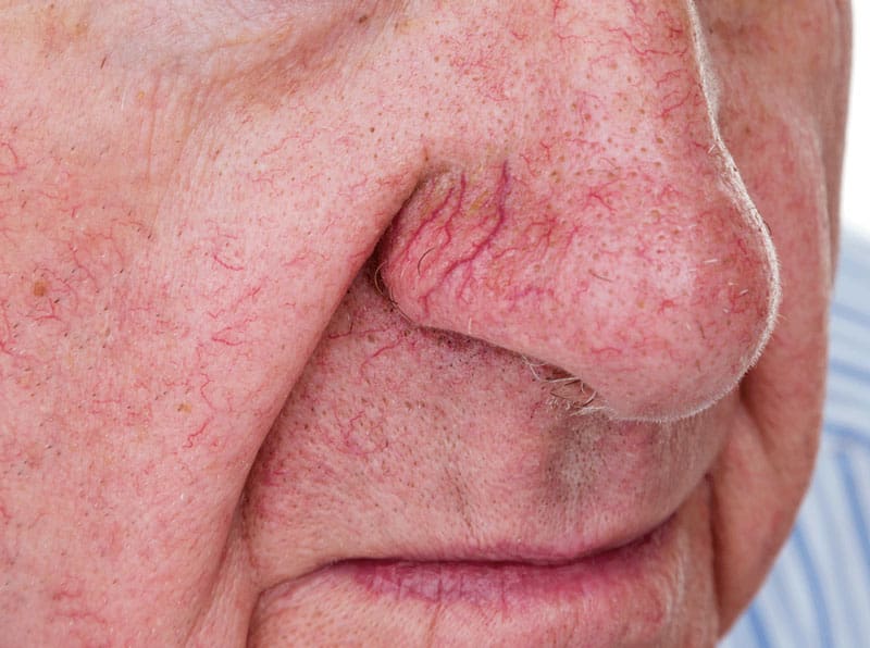 Facial Veins Image Facial Veins Image