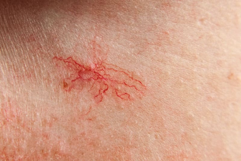 Visible Facial Veins Image Visible Facial Veins Image