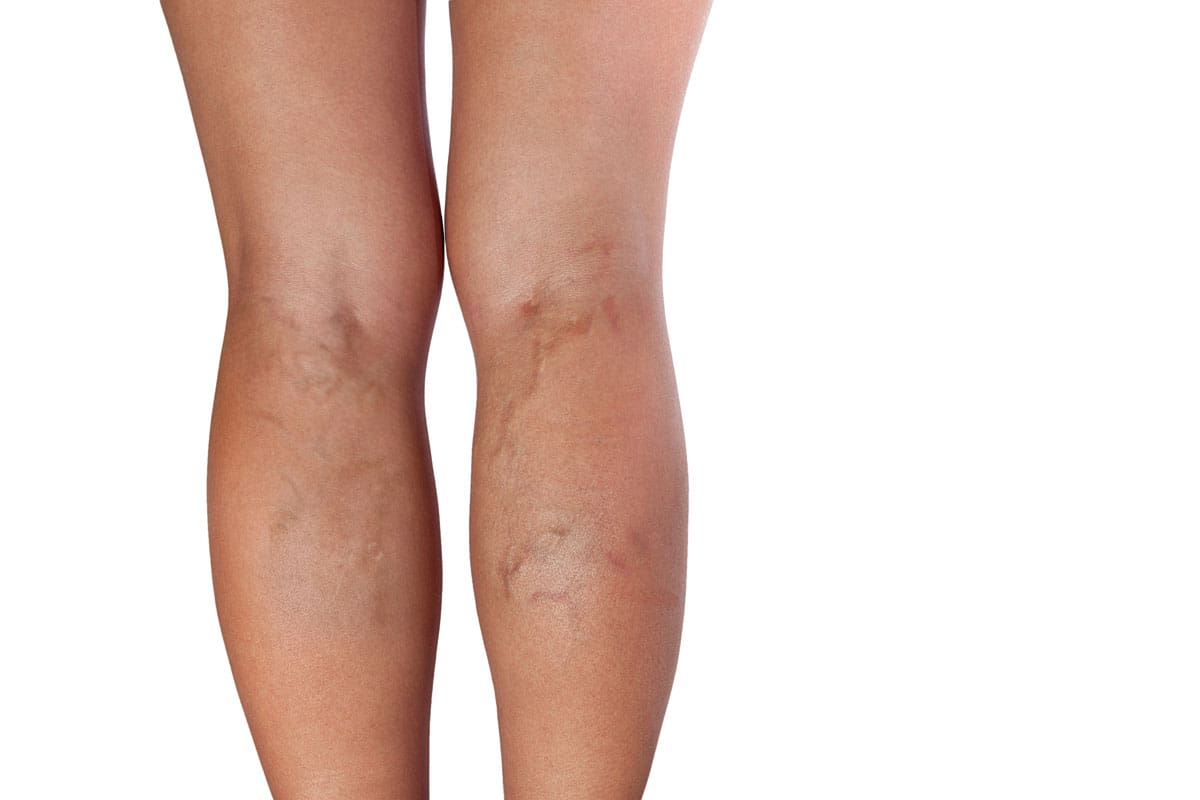 Legs 2 Legs 2