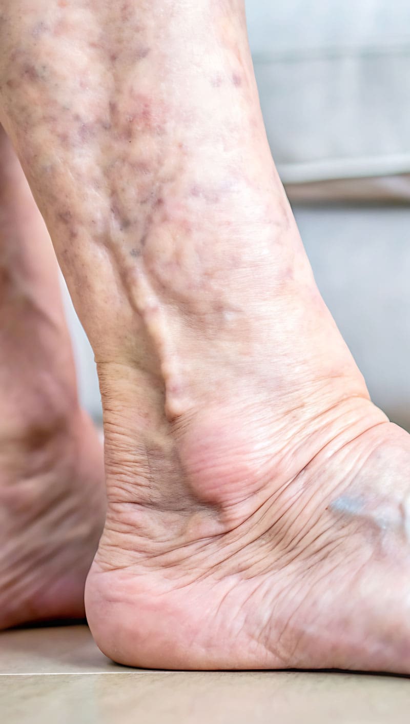 Ankle4 Ankle4