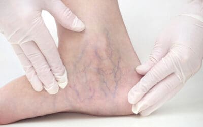 Are Spider Veins Dangerous? When to See a Doctor