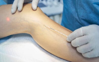 How Much Does Varicose Vein Treatment Cost With and Without Insurance