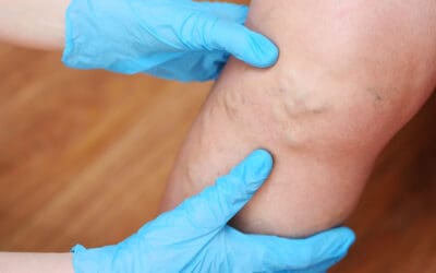 Can Varicose Veins Burst and Bleed? Warning Signs and Treatment Options