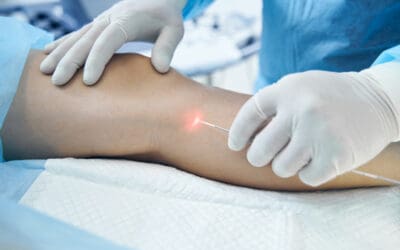 Endovenous Ablation: Treatment, Benefits, and Recovery