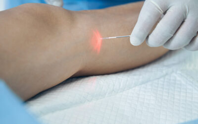 Insurance for Vein Treatment: What Are My Options?