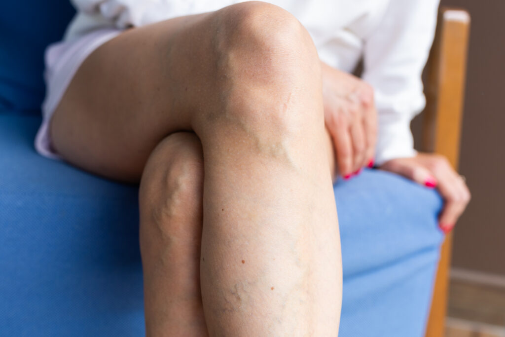 Close Up Of A Woman's Legs With Varicose Veins While Sitting Indoors