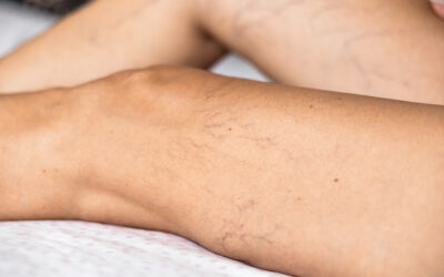 What Is Chronic Venous Insufficiency?