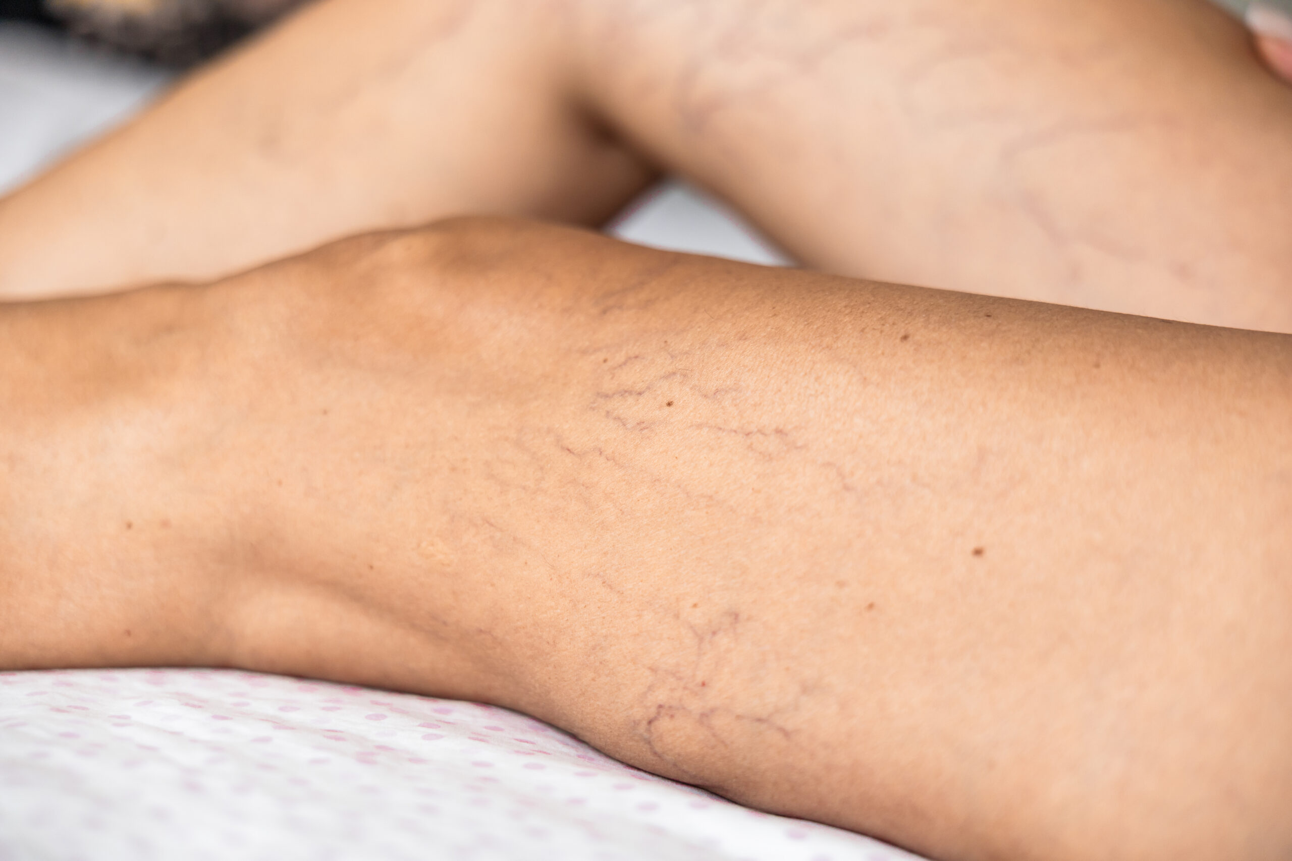 Close Up Of Lower Leg With Spider Veins And Superficial Telangiectasia. Visible Vascular Changes Associated With Chronic Venous Disease, Phlebology, Vascular Diagnostics, Prevention, And Medical Healt
