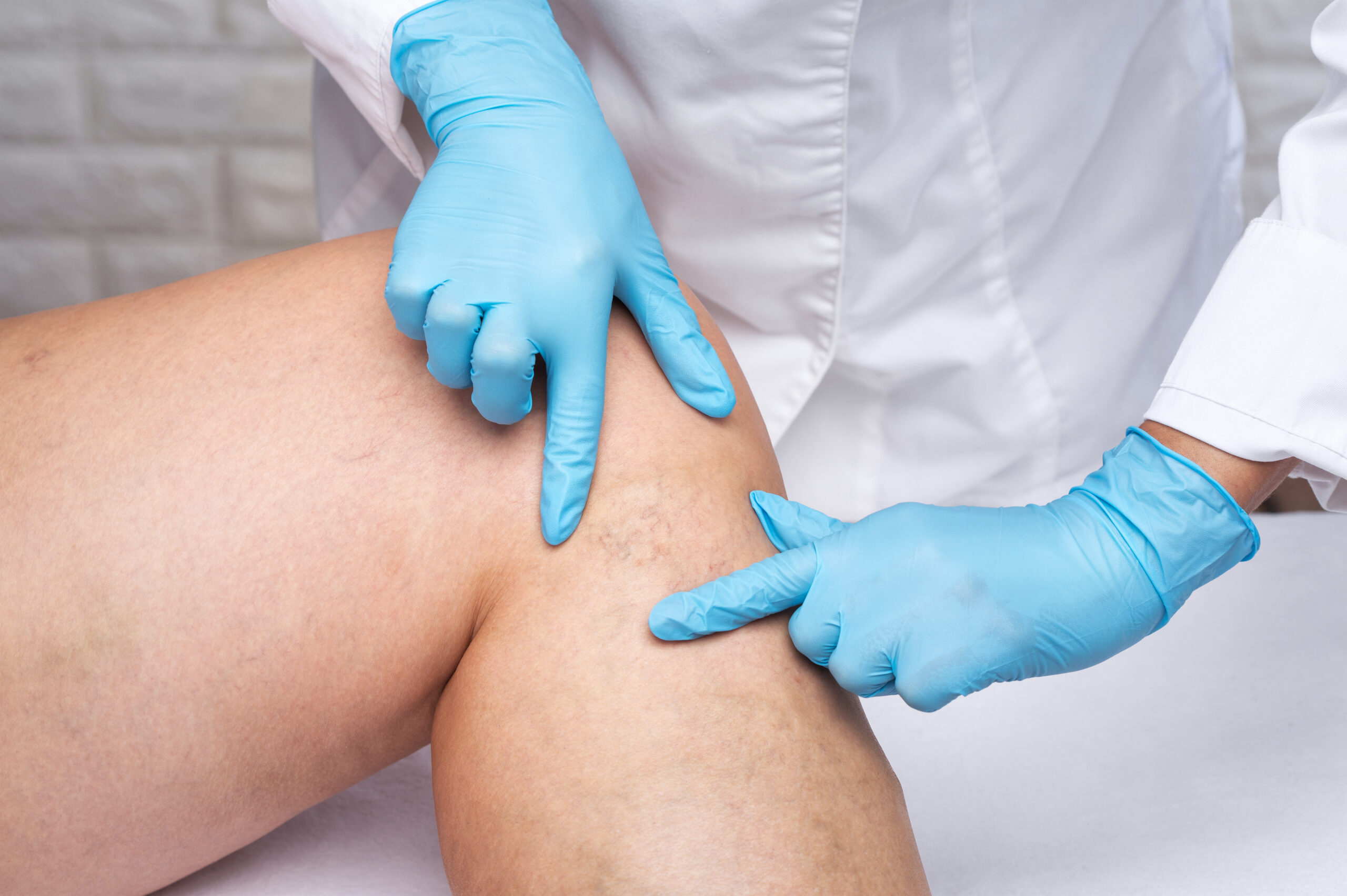 Removal Of Varicose Veins On The Legs. Medical Inspection And Treatment Of Telangiectasia. Phlebeurysm.