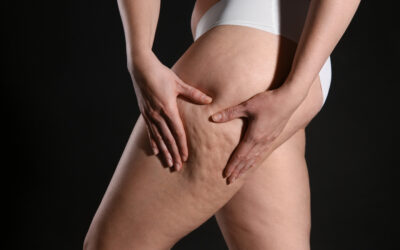 Lipedema or Just Fat Legs? How to Tell the Difference