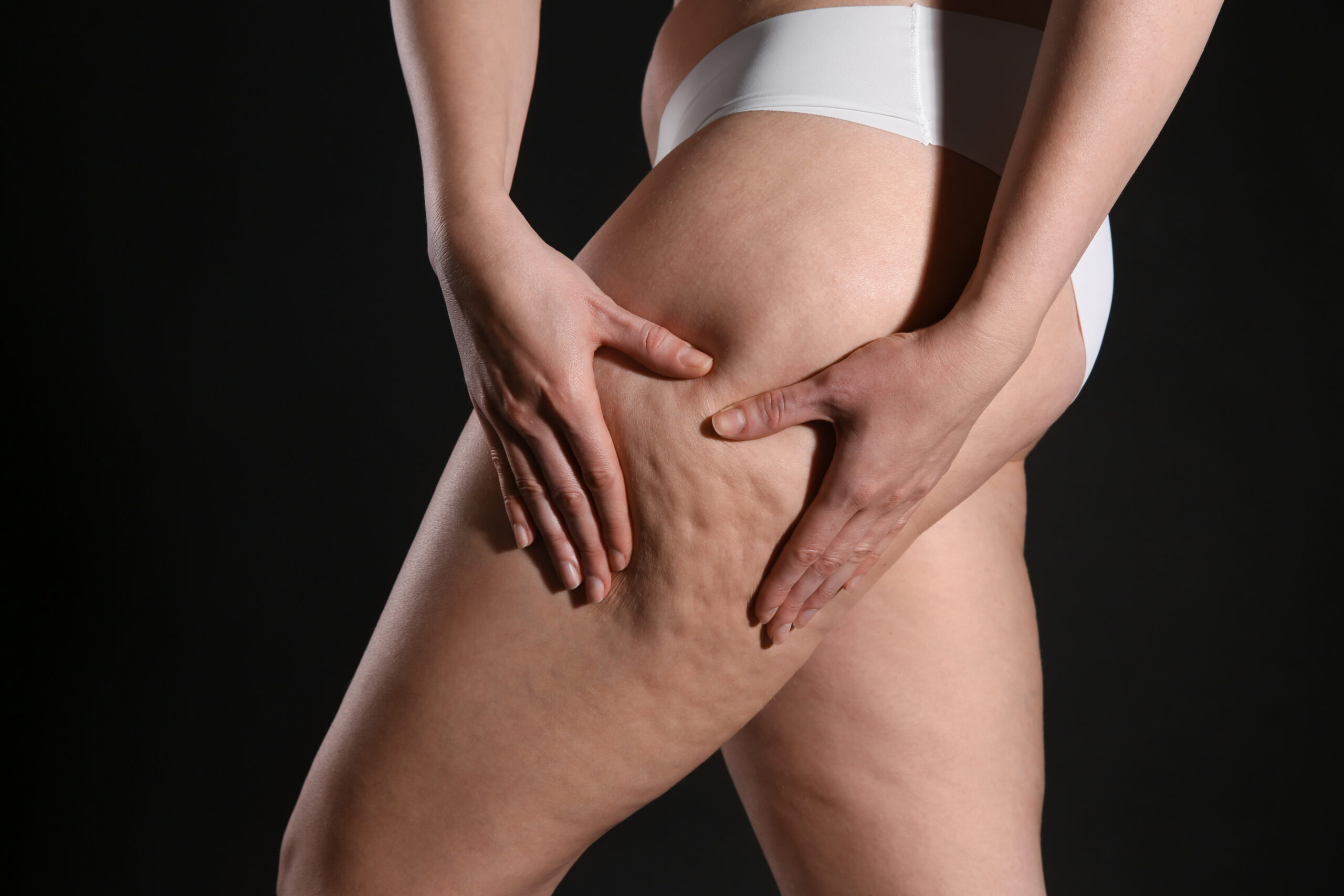 Woman With Cellulite On Black Background, Closeup
