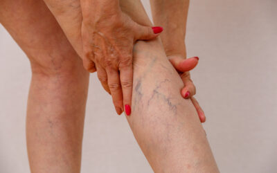 Are Varicose Veins Dangerous? Warning Signs You Shouldn’t Ignore